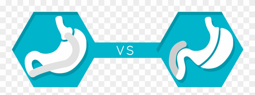 Gastric Bypass Vs Duodenal Switch Surgery Comparison - Gastric Bypass Surgery Clipart