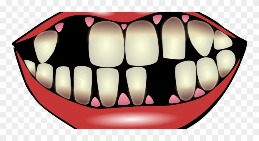 Missing Teeth Dentist - Perdida De Dientes Dibujo Clipart