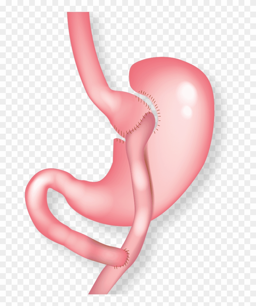 Gastric Bypass - Gastric Bypass Surgery Clipart