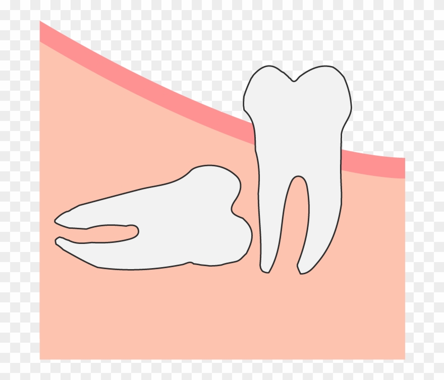 Horizontal Wisdom Tooth Impaction Clipart