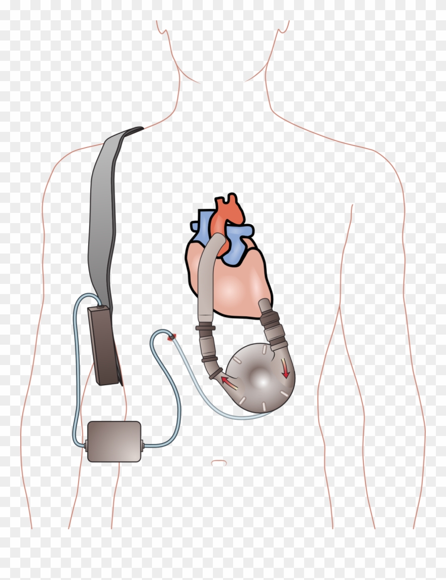 Aparato De Asistencia Ventricular Clipart