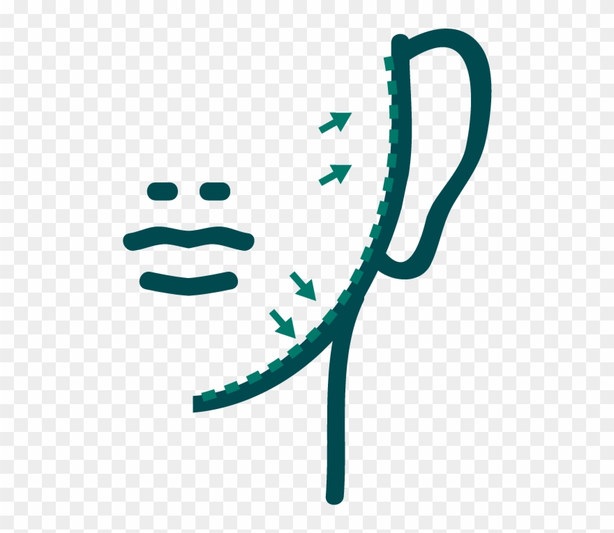 Face Lift2-01 - Botulinum Toxin Clipart