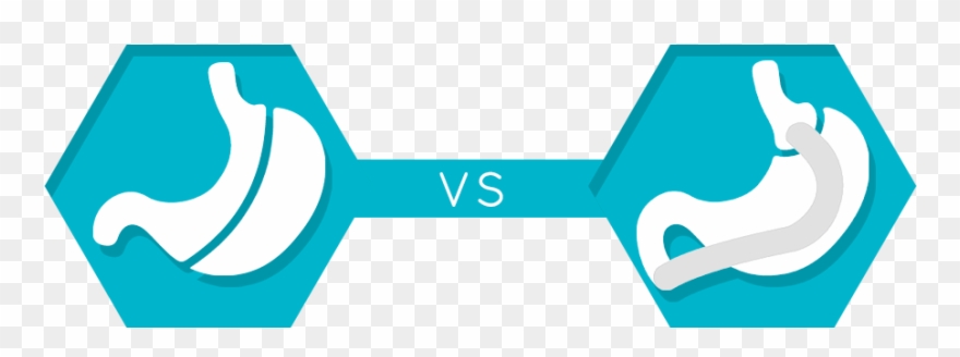 Gastric Sleeve Vs Gastric Bypass Overview - Gastric Bypass Surgery Clipart