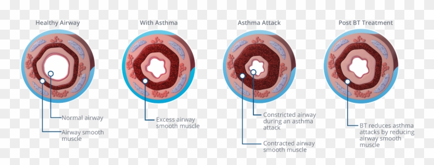 As Asthma Symptoms Increase, The Dosage Level And Number - Bronchial Thermoplasty Clipart