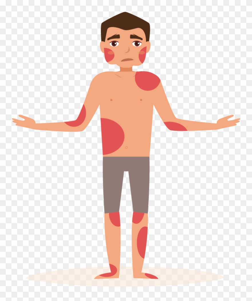 Eczema - Eczema Clip Art - Png Download