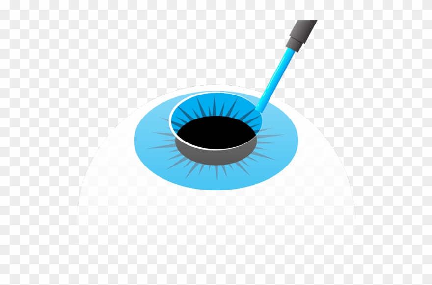Immediately After Treatment, A Bandage Contact Lens - Circle Clipart