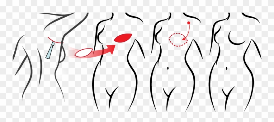 Icap Procedure - Flap Clipart