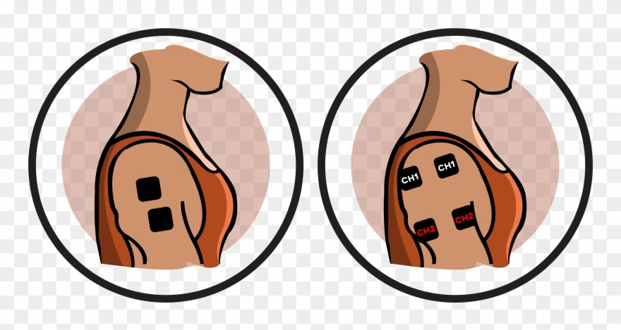 Mobility And Health Program - Transcutaneous Electrical Nerve Stimulation Clipart