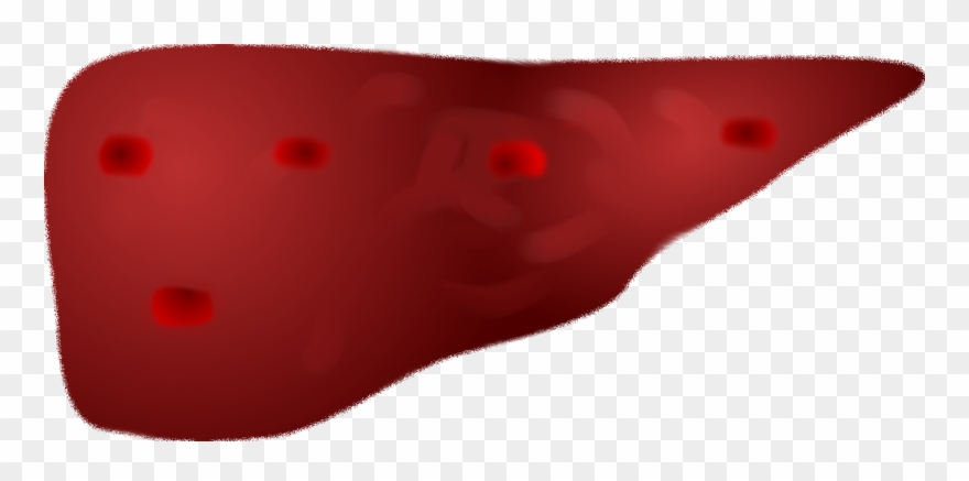 Metastatic Liver - Illustration Clipart