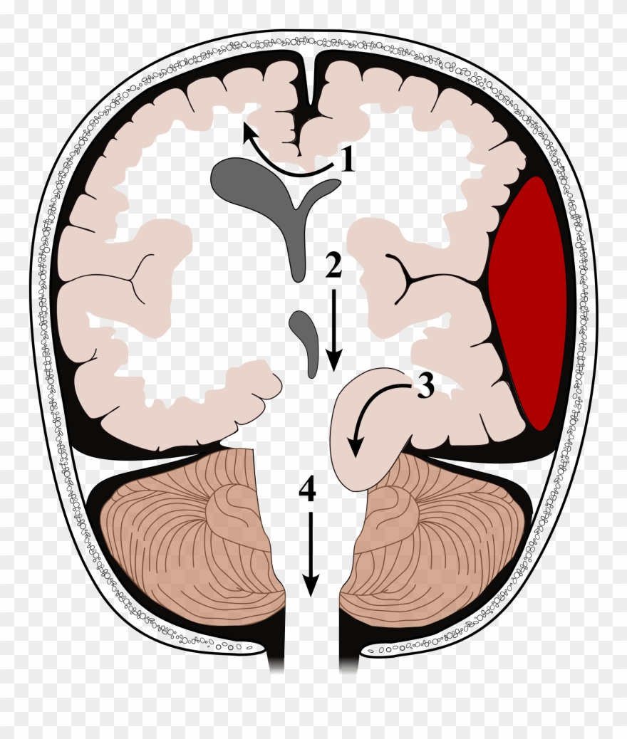 Open - Types D Engagement Cérébral Clipart