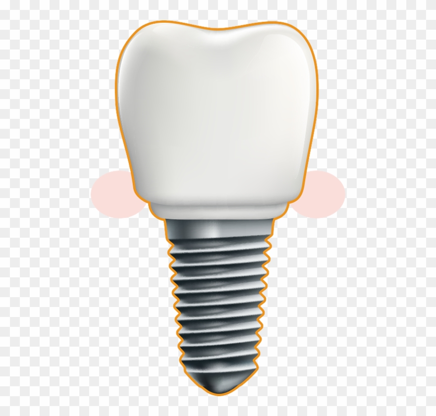 Dental Implant - Illustration Clipart