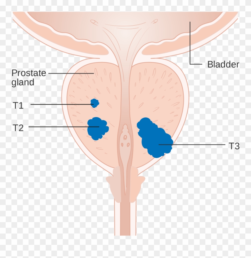 Prostate Cancer Affects Almost A Quarter Of A Million - Prostate Clipart