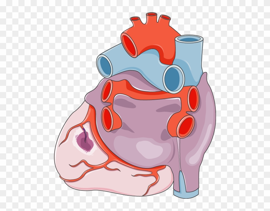 Infarctus Du Myocarde - Schéma D Un Infarctus Clipart