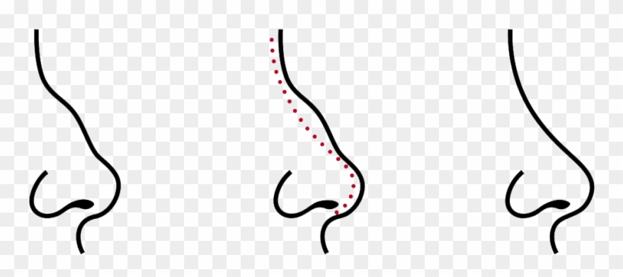 Care Must Be Taken For Several Weeks After Surgery - Rhinoplasty Drawing Clipart