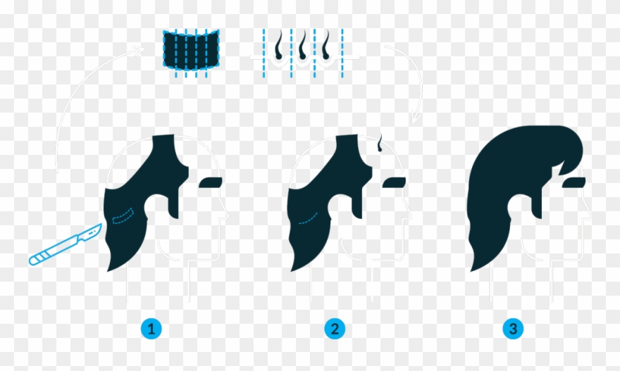 Follicular Unit Grafting Clipart