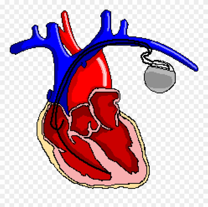 Ppg Change Complications - Portable Network Graphics Clipart