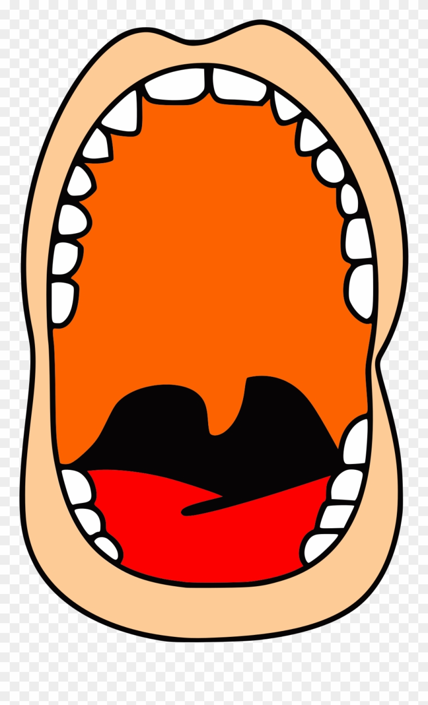 Open - Pharyngeal Flap Surgery Clipart
