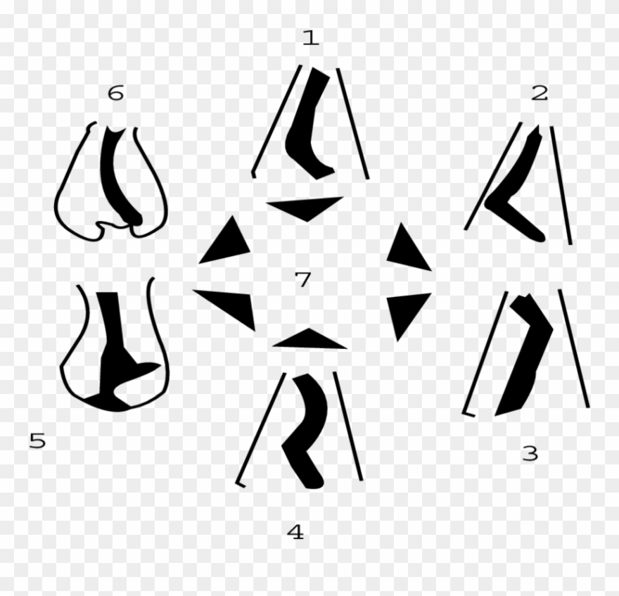 The Mladina Classification Of Nasal Septal Deviations - Mladina Classification Of Septal Deviation Clipart
