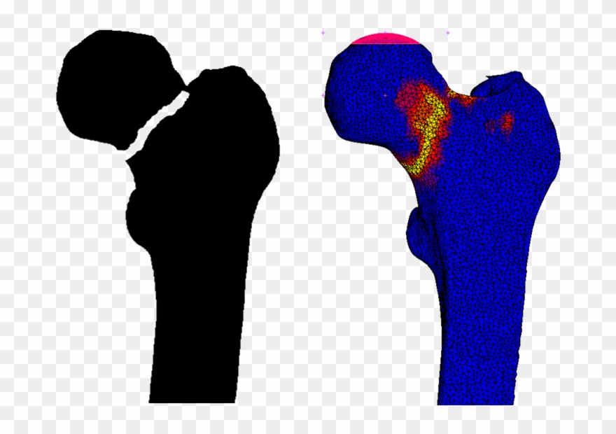 Example Of Femoral Fracture Prediction - Radboud University Medical Center Clipart