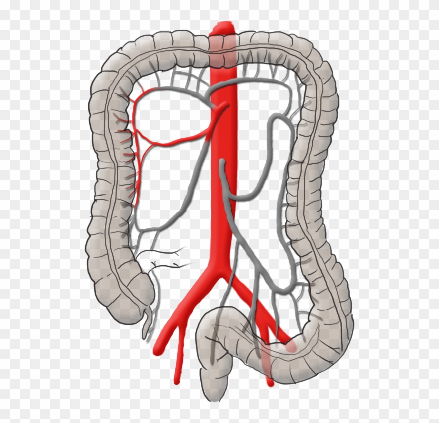 Right Colic Artery - Kolonkarzinom Operation Clipart
