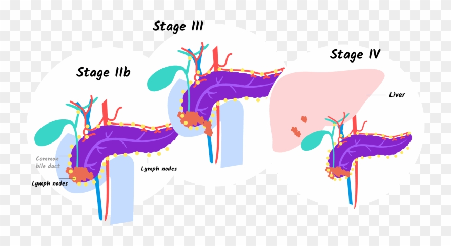 Illustration Of Stages Iib, Iii, And Iv Of Pancreatic Clipart