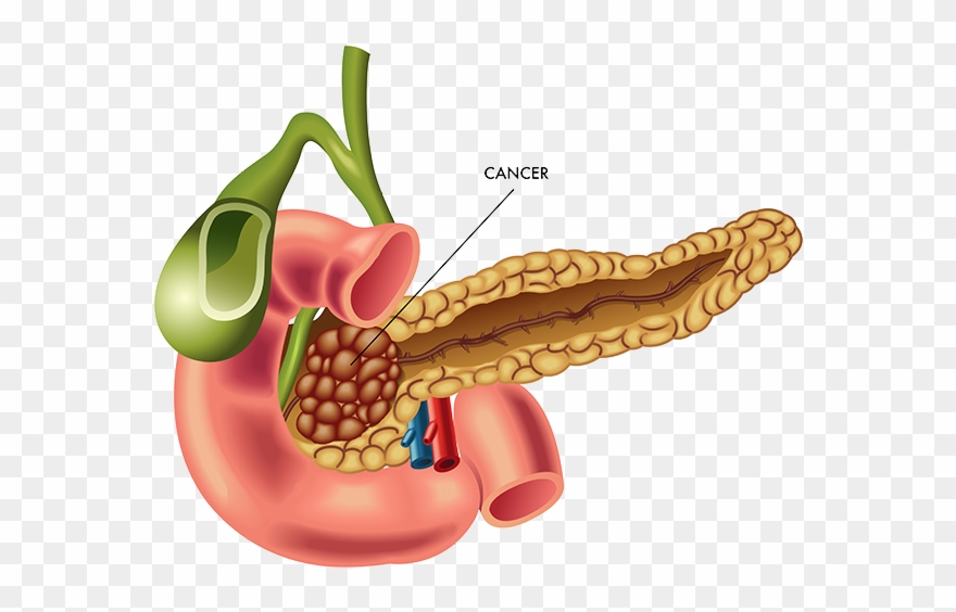 Tumors We Treat - Qu Est Ce Que La Jaunisse Chez L Adu Clipart