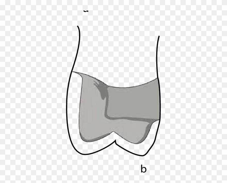 Coping Design For A Metal-ceramic Restoration With - Ceramic Clipart