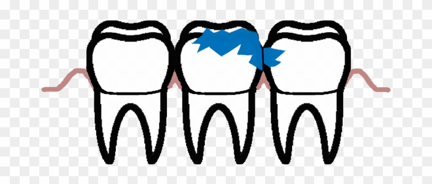It Never Heals Spontaneously, But Leads To Complications - Tooth Decay Clipart