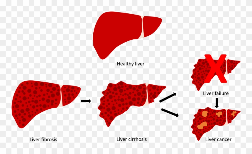 Hepatitis Awareness Day - Hepatitis Clipart