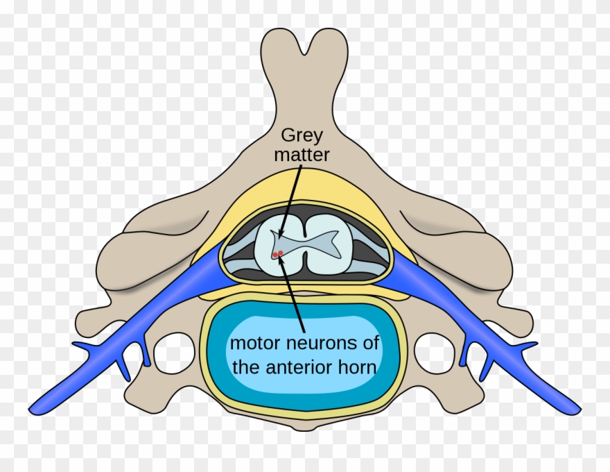 Spinal Muscular Atrophy Wikipedia - Spinal Polio Clipart
