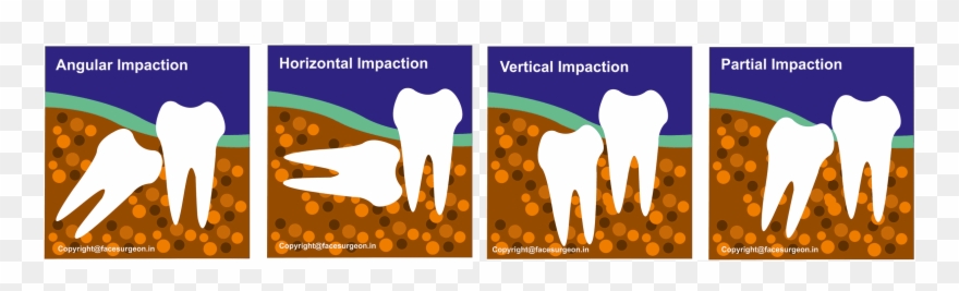 Different Types Of Impaction Clipart