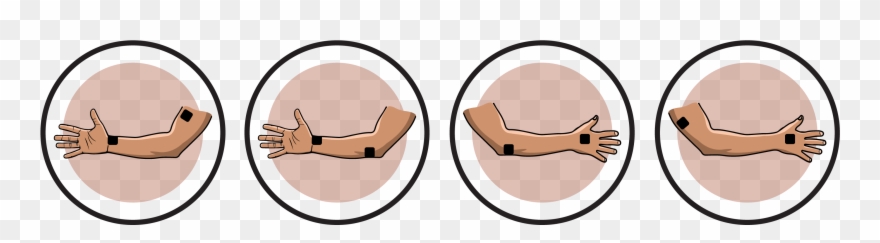 Ulnar Nerve Lesion Electrode Pad Placement Clipart