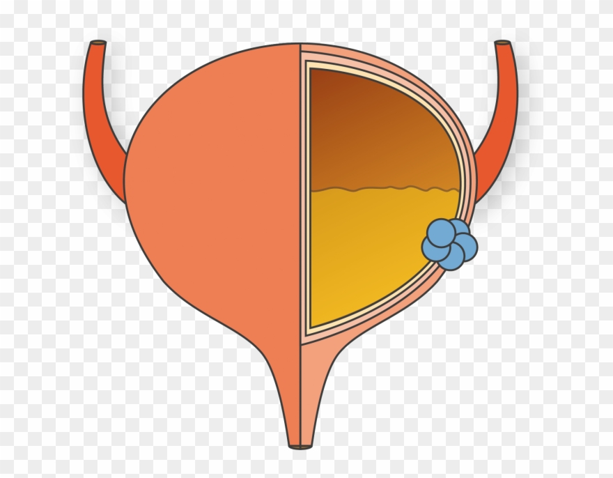 About Bladder Cancer - Bladder Cancer Png Clipart