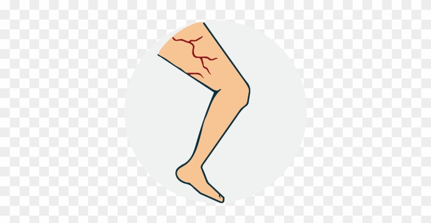 Varicose Vein Clipart