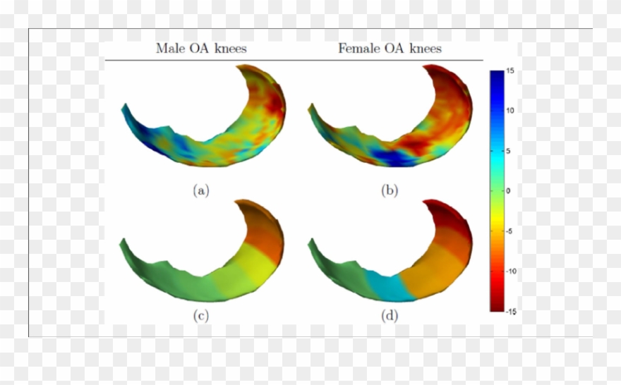 Gender-specific Changes In Medial Femoral Cartilage Clipart