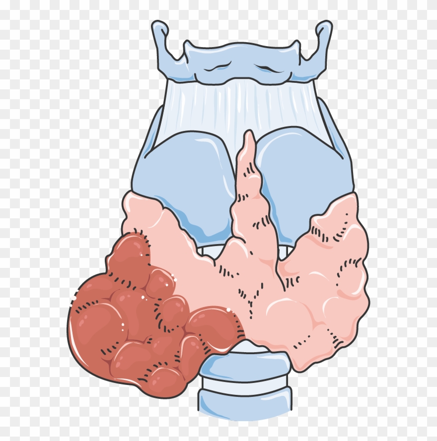 Cancer De La Thyroïde Clipart