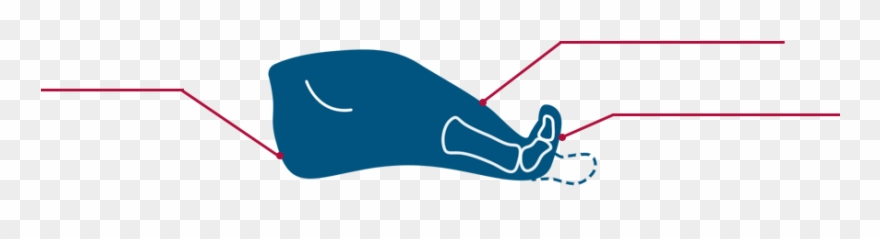 Bone Spur Removal » Clipart