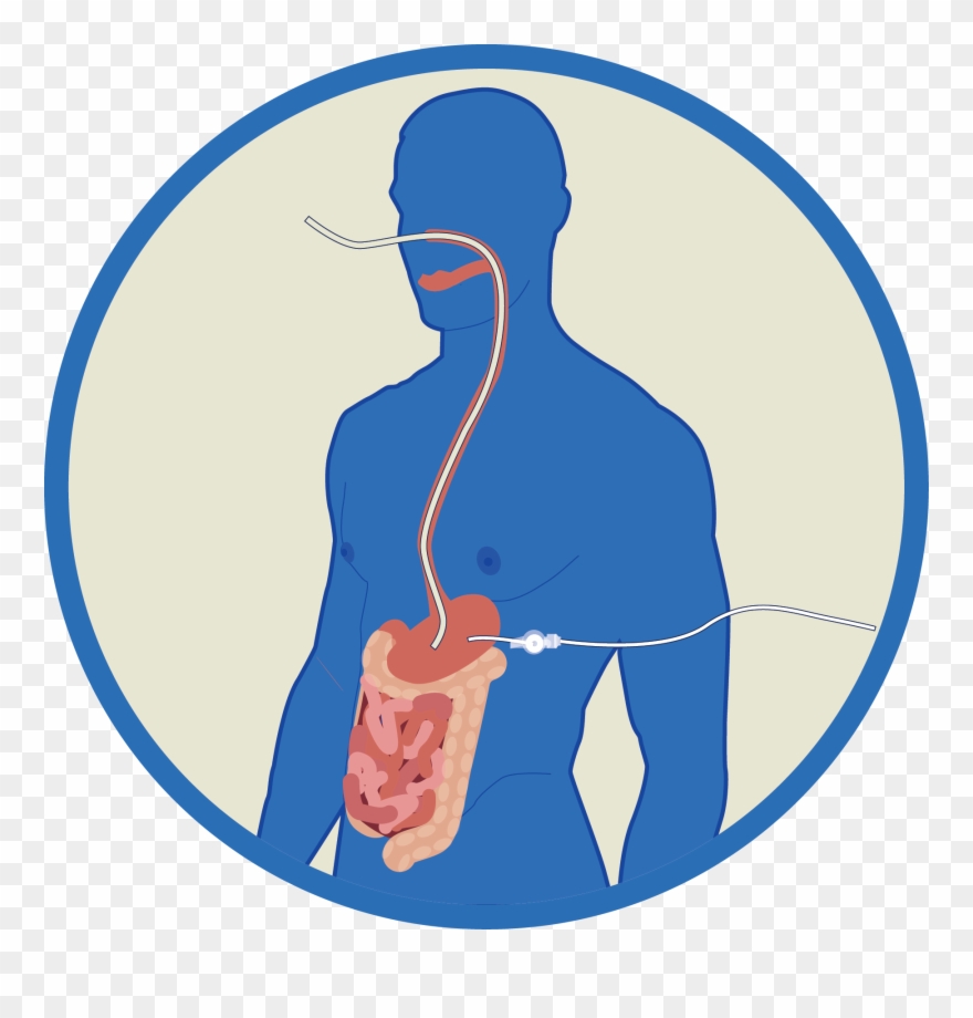 Enteral Tube Feeding Nasogastric , Nasojejunal (nj), Clipart (2856129