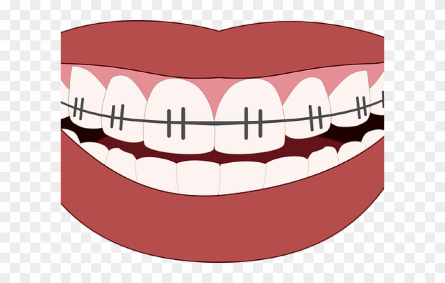 Tools Clipart Orthodontic - Png Download