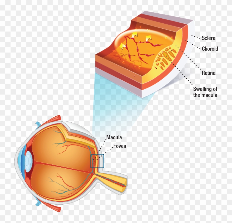 Photo Of A Retina With Diabetic Macular Edema Clipart