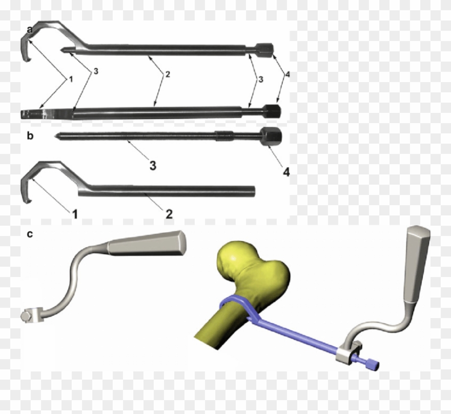24 Extracortical Clamp Device For Diaphyseal Fi Xation Clipart