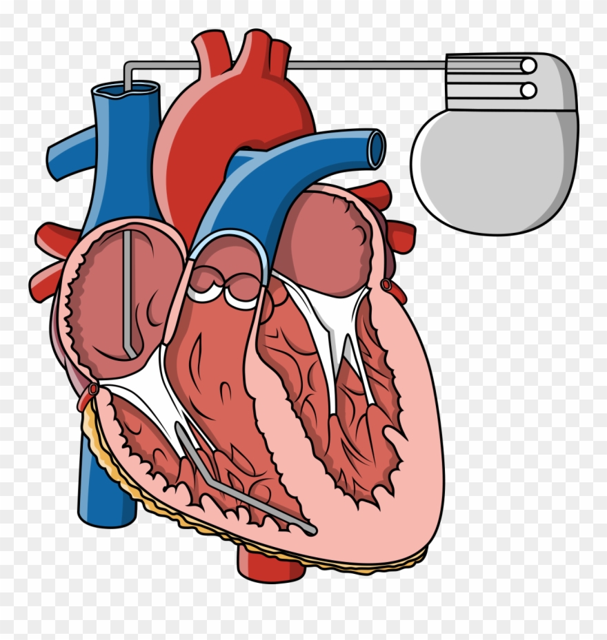 Pacemaker Information And Support Pt 2 Survey Clipart