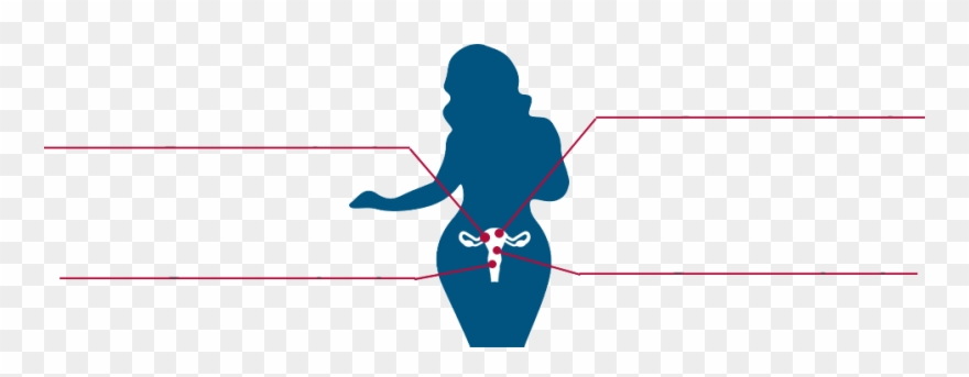 Second Degree Uterine Prolapse » Clipart
