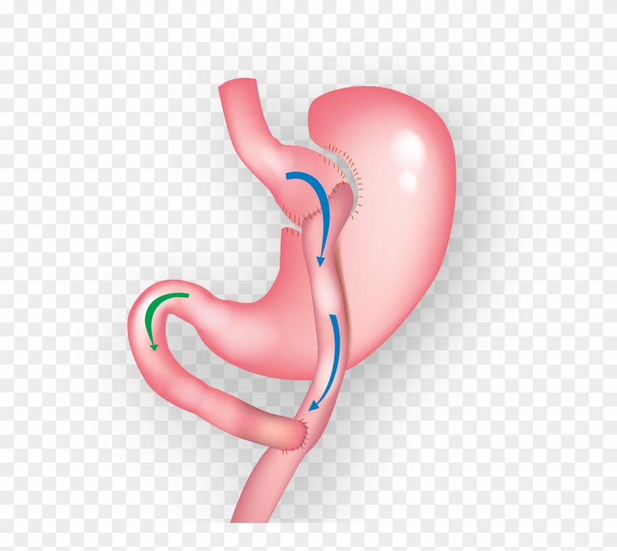 Demonstration Of Gastric Bypass Surgery Clipart