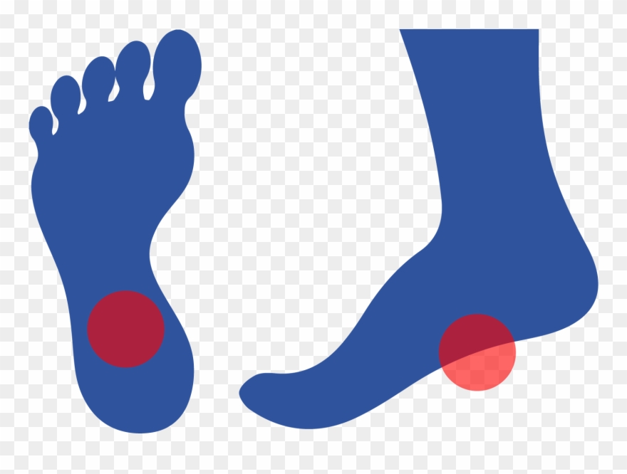 Plantar Fasciitis Is Caused By Inflammation Of A Thick Clipart