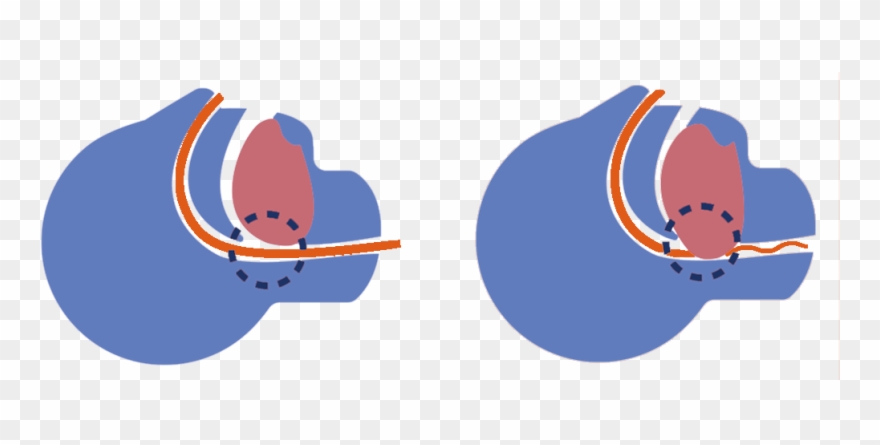 Sleep Apnoea Obstructed Airways Melissa Loo 2017 02 Clipart