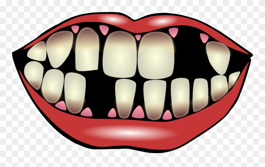 Clipart Of Teeth, Affects And Pediatric - Png Download