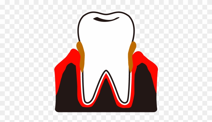 Dental Plaque Calculus Periodontal Hospital View All Clipart