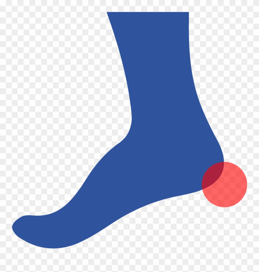 A Heel Spur Is A Calcium Deposit That Forms A Small - Sock Clipart