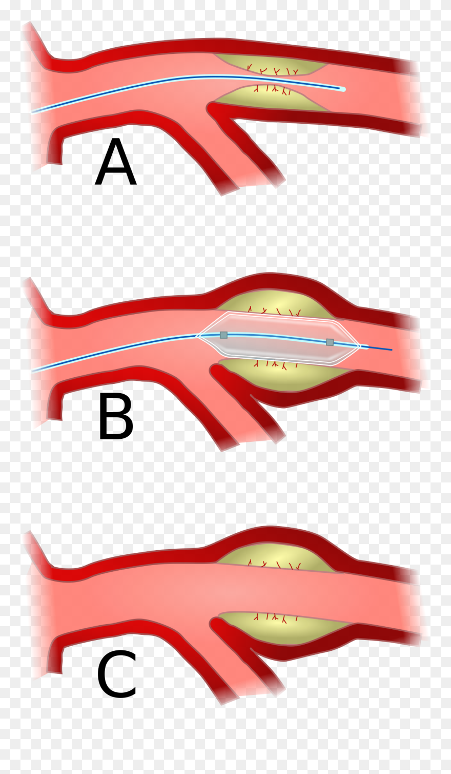 Balloon Angioplasty - Percutaneous Coronary Intervention Hd Clipart